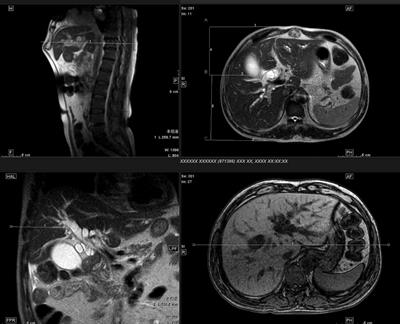 Application value of computed tomography and magnetic resonance imaging three-dimensional reconstruction and digital subtraction angiography in percutaneous transhepatic cholangial drainage